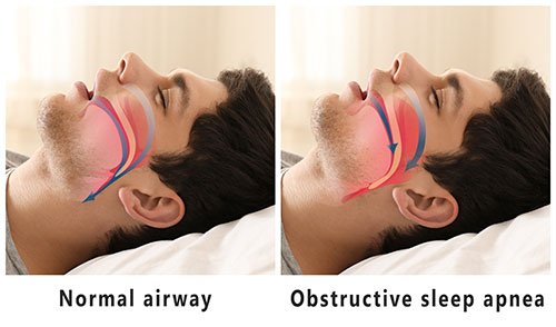 Sleep Better Jersey | Snoring Treatment, Oral Appliance Therapy and Sleep Apnea